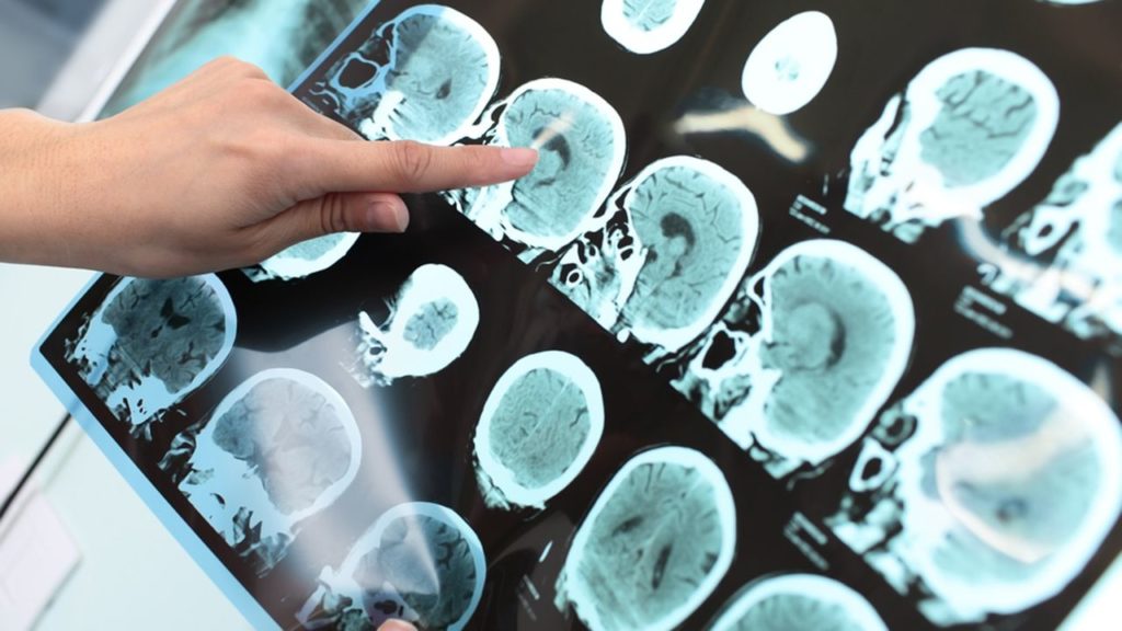 Entenda o que é a Doença de Alzheimer - SUPERA - Ginástica para o Cérebro